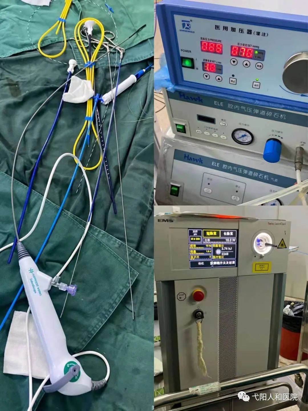 输尿管软镜下钬激光碎石术是利用人体自然腔道(notes手术)进行的一项